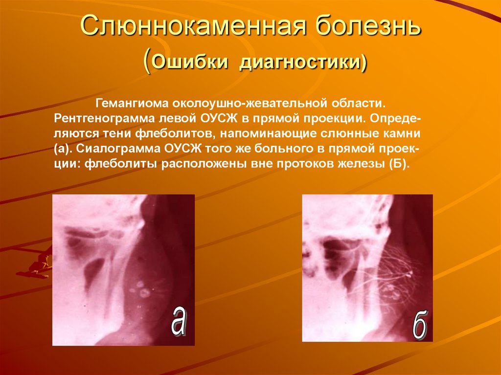 Слюннокаменная болезнь (Ошибки диагностики)