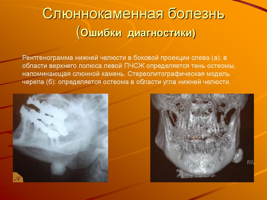 Слюннокаменная болезнь (Ошибки диагностики)