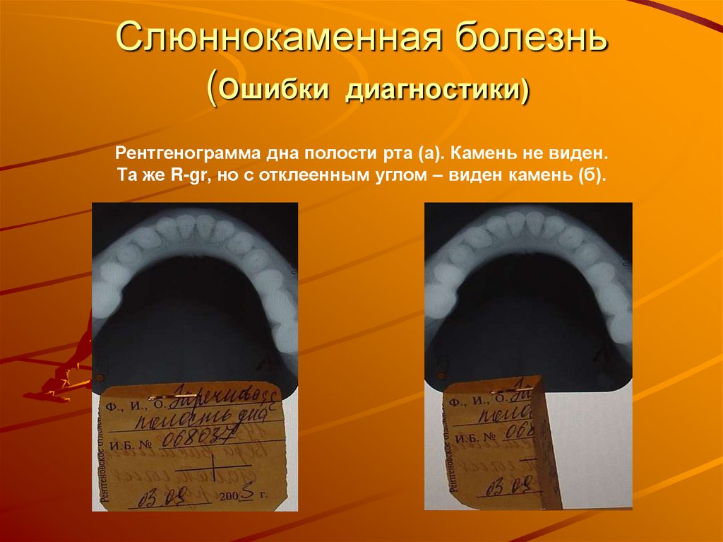 Слюннокаменная болезнь (Ошибки диагностики)