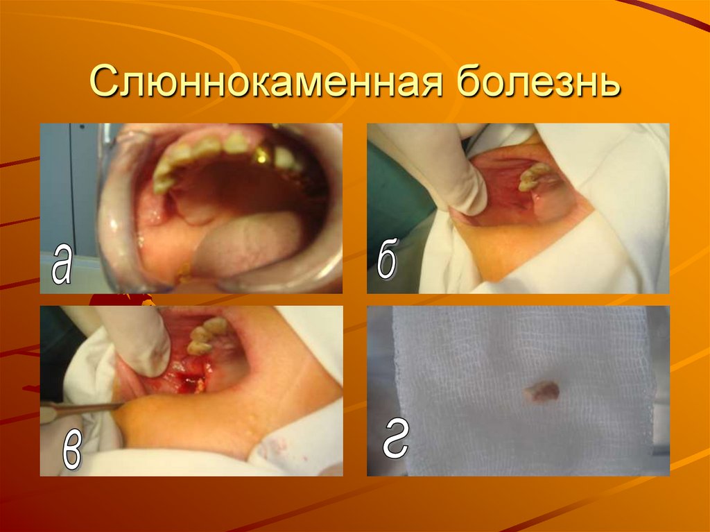 Слюннокаменная болезнь