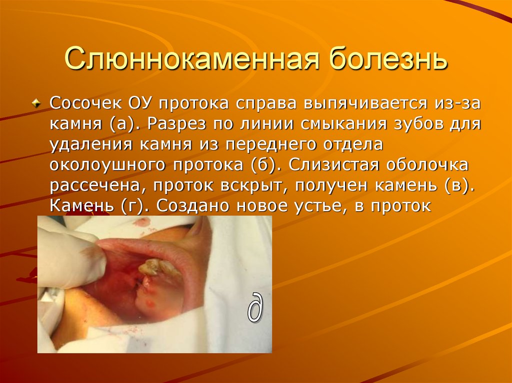 Слюннокаменная болезнь