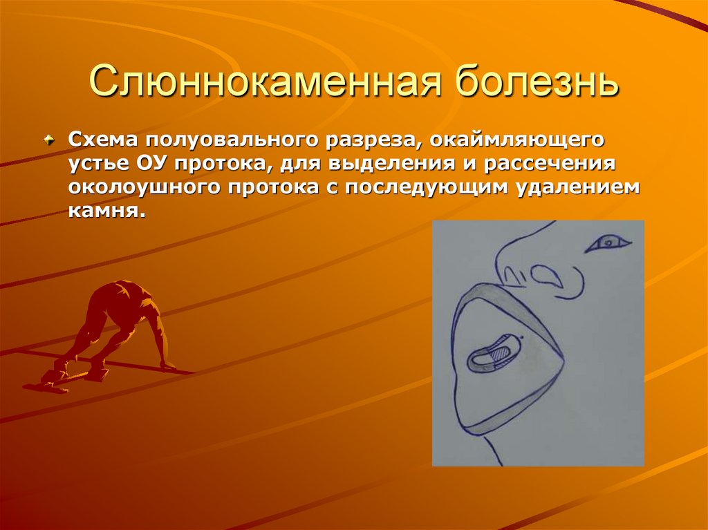 Слюннокаменная болезнь