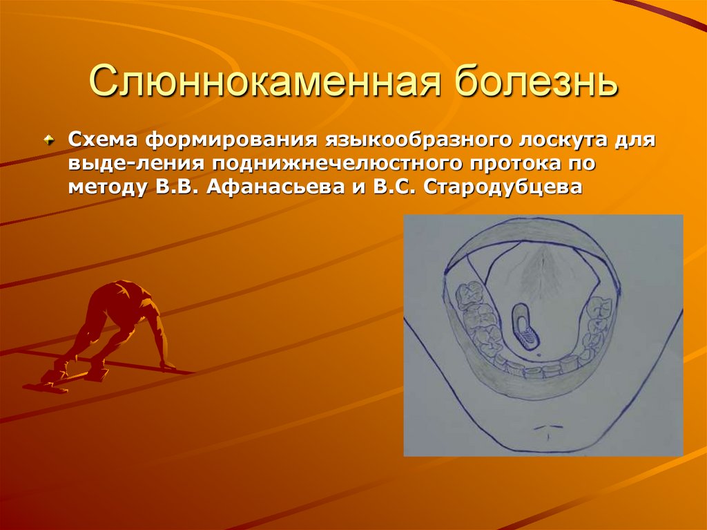 Слюннокаменная болезнь