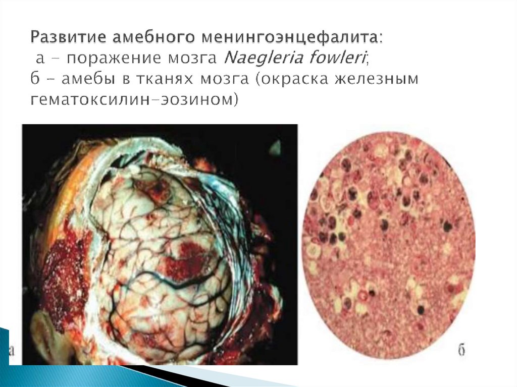 Развитие амебного менингоэнцефалита: а - поражение мозга Naegleria fowleri; б - амебы в тканях мозга (окраска железным
