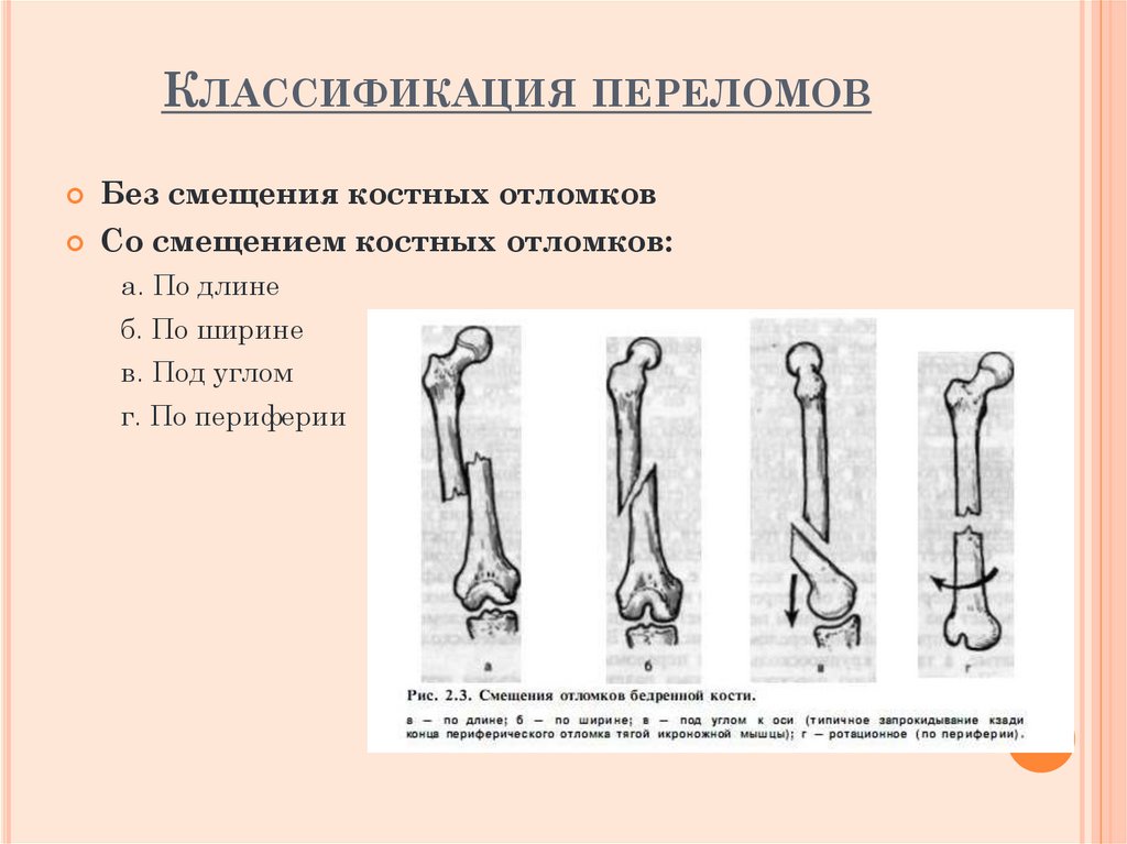 Классификация переломов