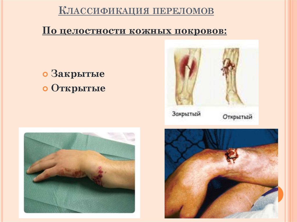 Классификация переломов