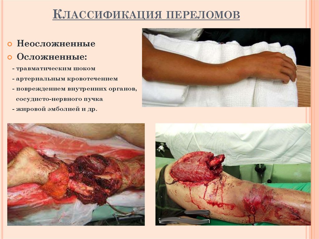 Классификация переломов