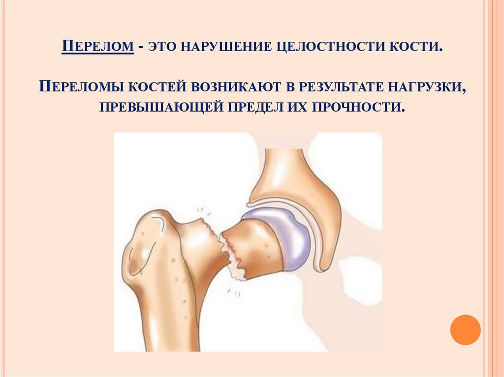Перелом - это нарушение целостности кости. Переломы костей возникают в результате нагрузки, превышающей предел их прочности.