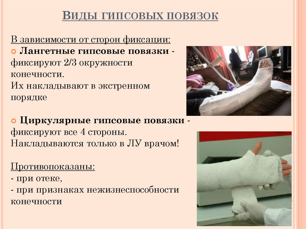 Виды гипсовых повязок