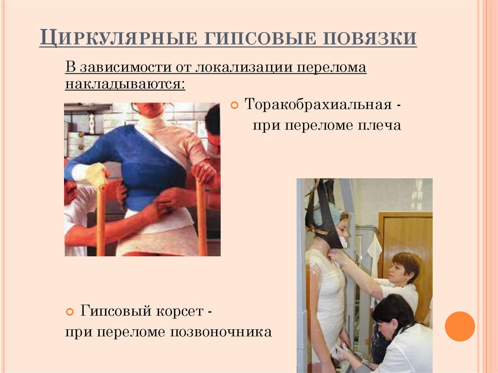 Циркулярные гипсовые повязки