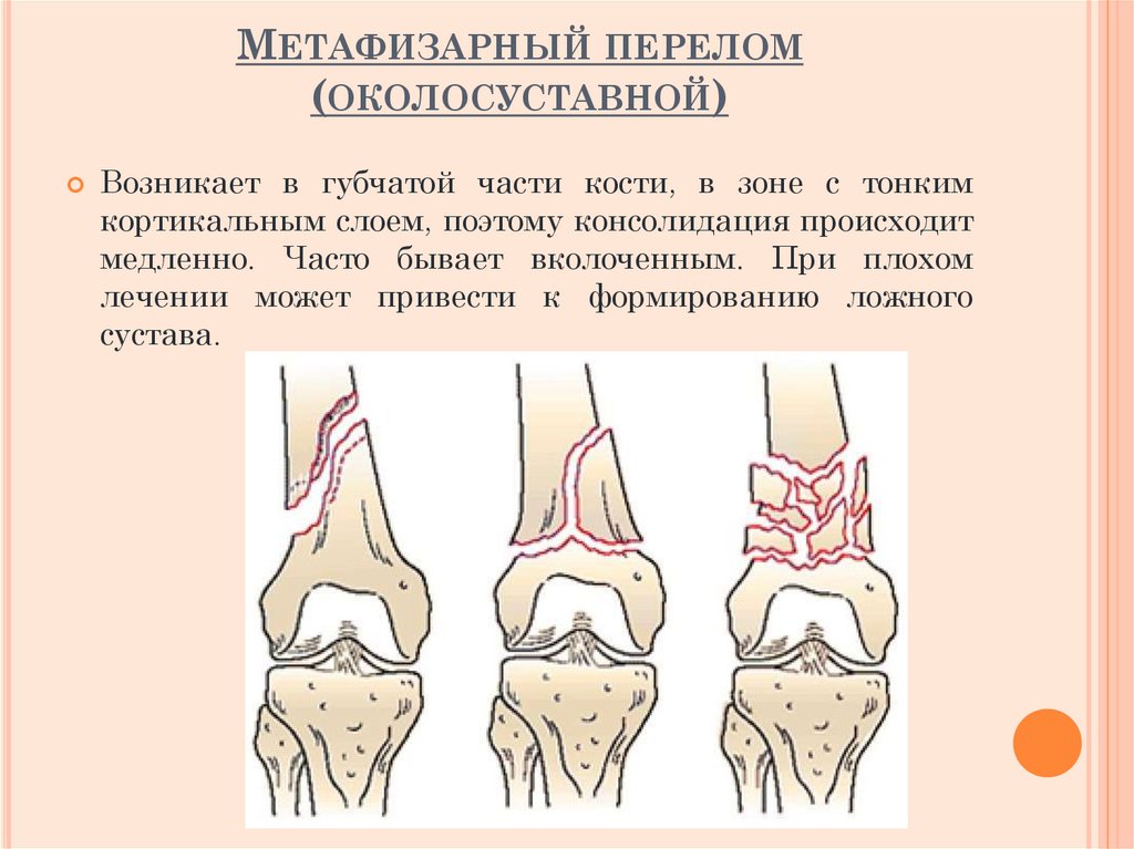 Метафизарный перелом (околосуставной)
