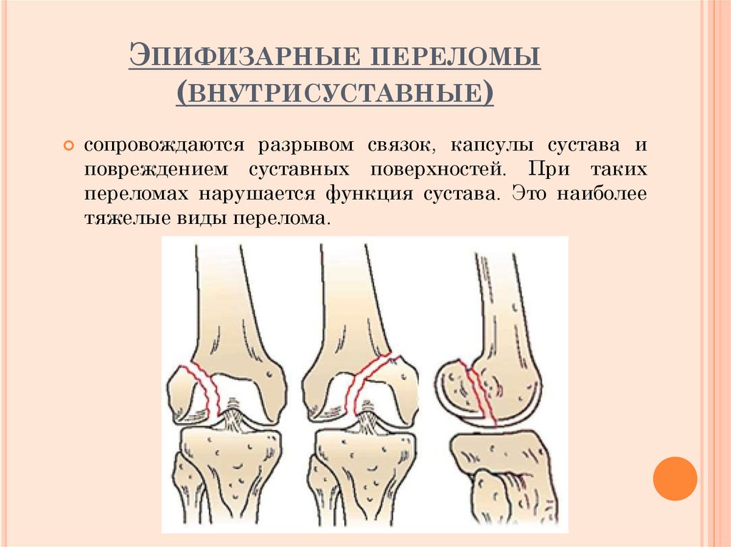 Эпифизарные переломы (внутрисуставные)