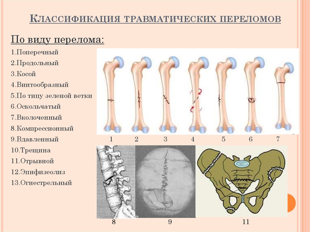 Классификация травматических переломов
