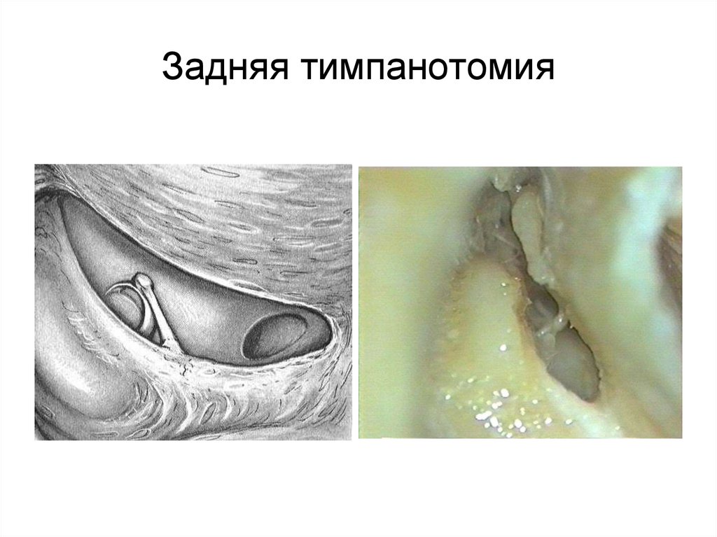 Задняя тимпанотомия