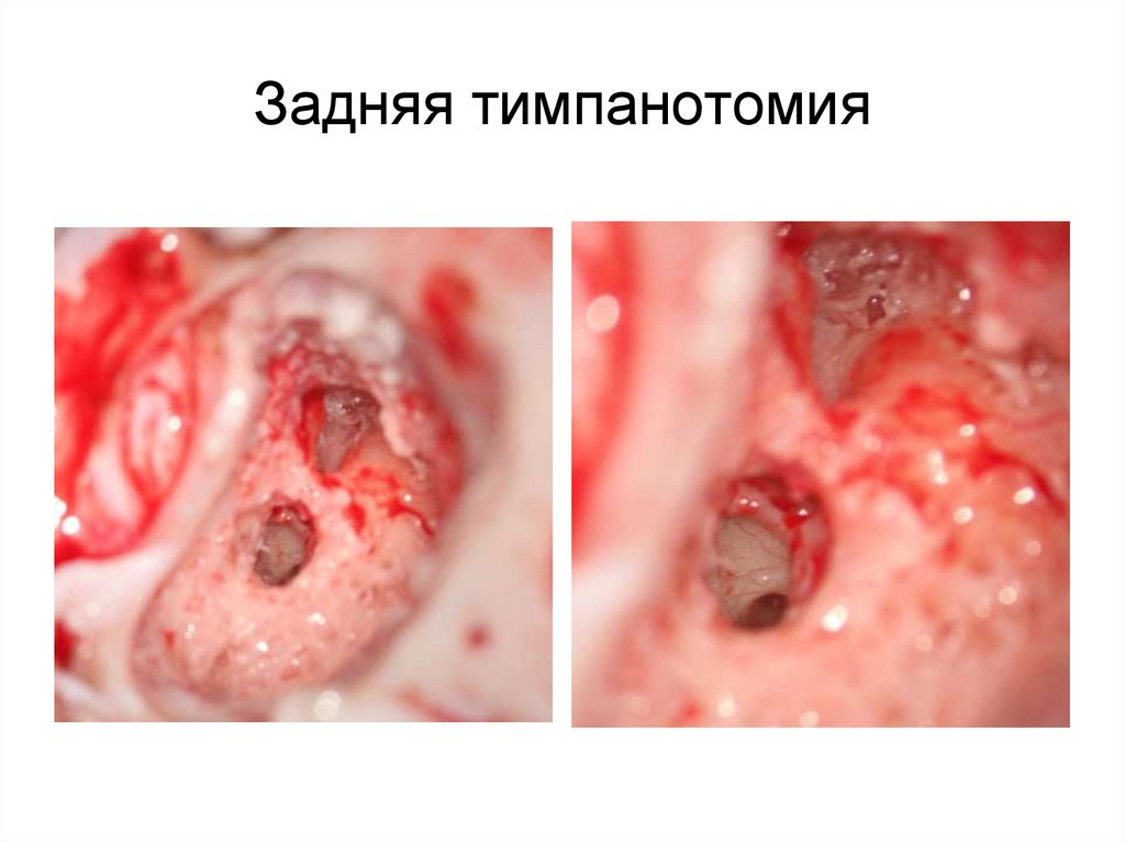 Задняя тимпанотомия
