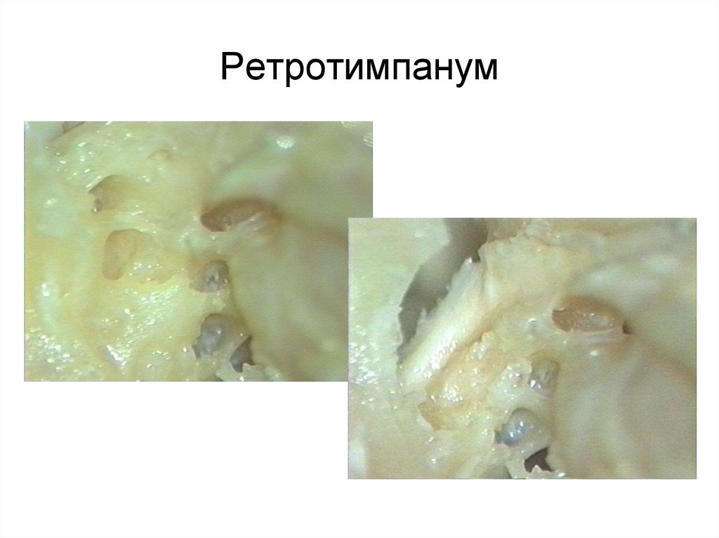 Ретротимпанум