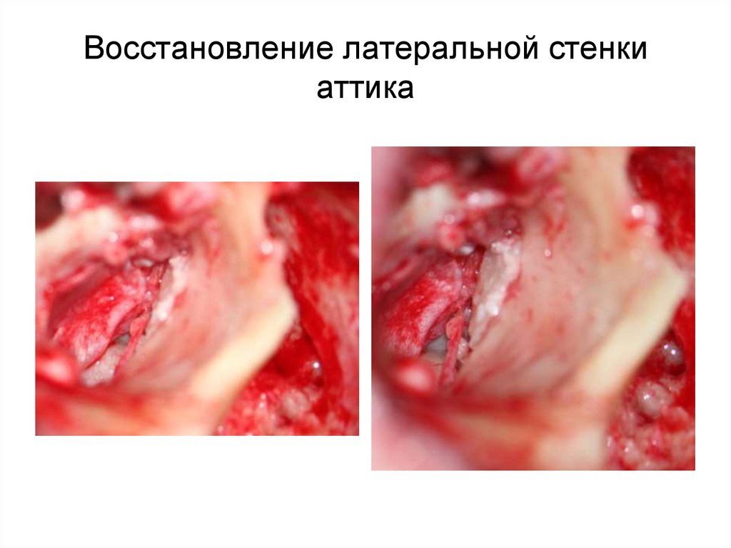 Восстановление латеральной стенки аттика
