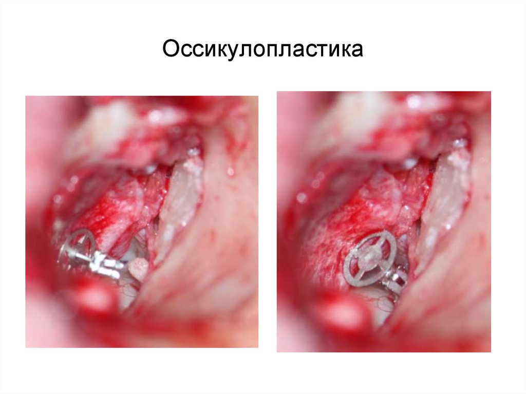 Оссикулопластика