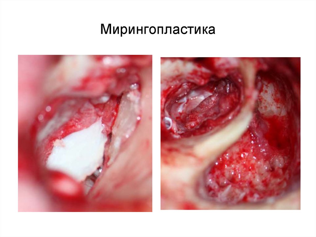 Мирингопластика