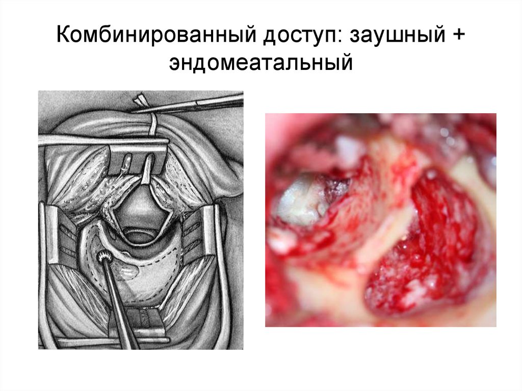 Комбинированный доступ: заушный + эндомеатальный