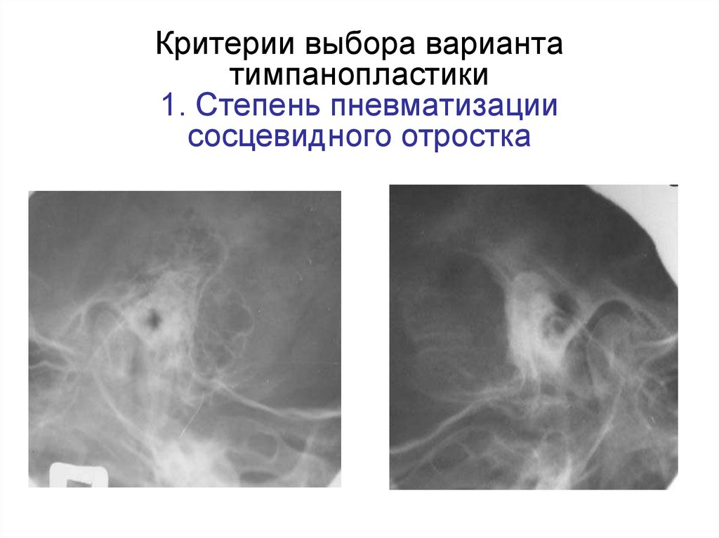 Критерии выбора варианта тимпанопластики 1. Степень пневматизации сосцевидного отростка