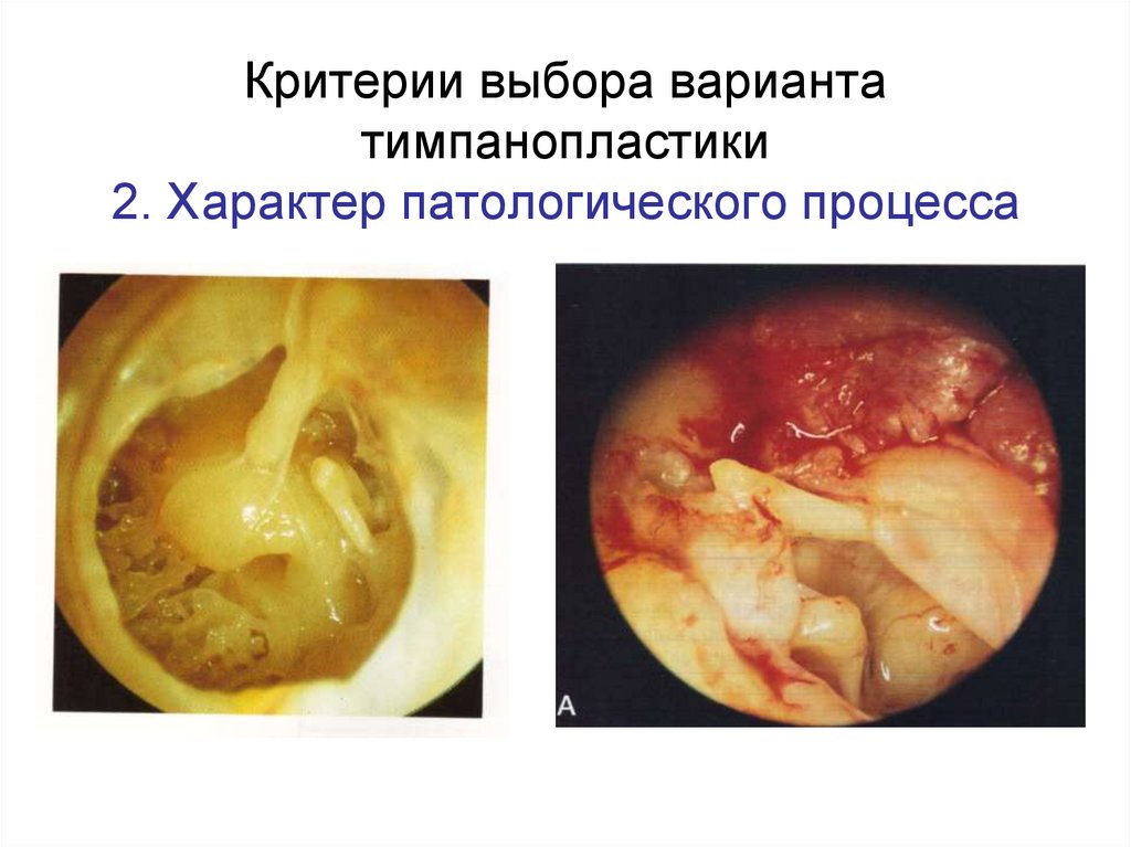 Критерии выбора варианта тимпанопластики 2. Характер патологического процесса