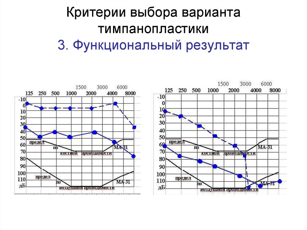 Критерии выбора варианта тимпанопластики 3. Функциональный результат