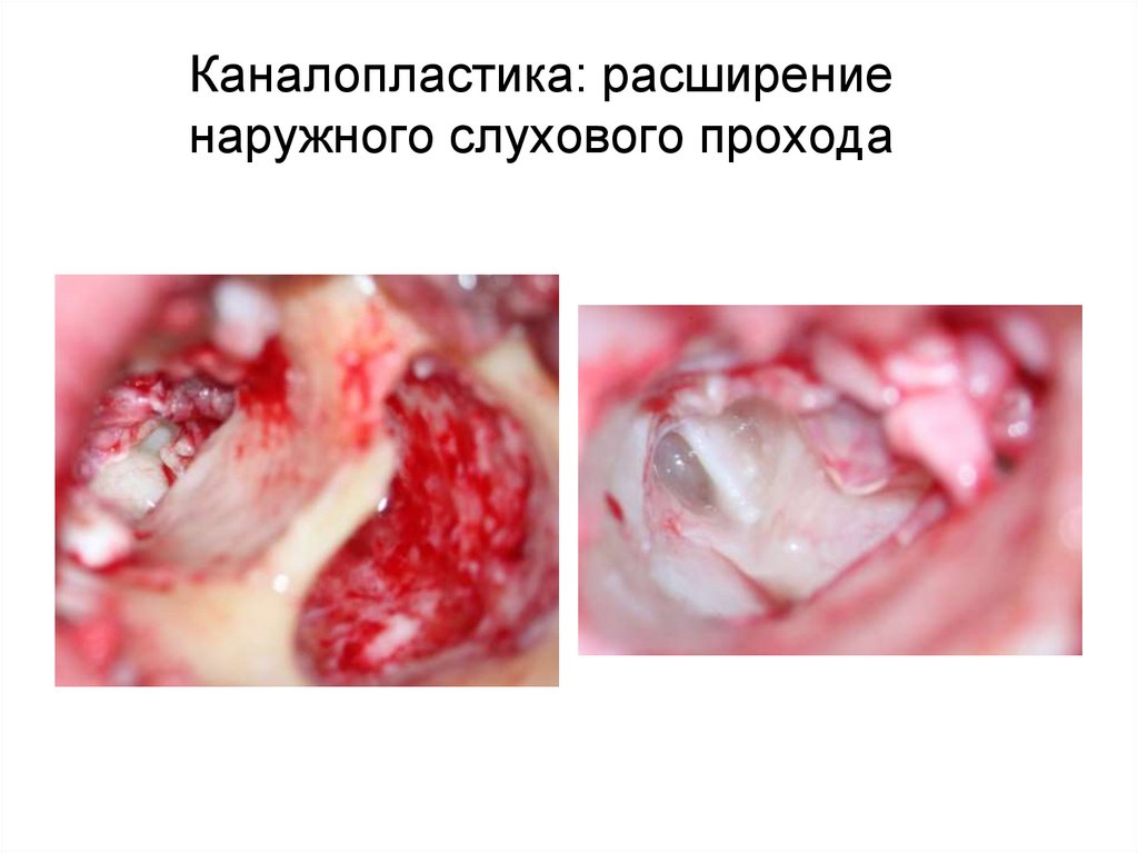 Каналопластика: расширение наружного слухового прохода