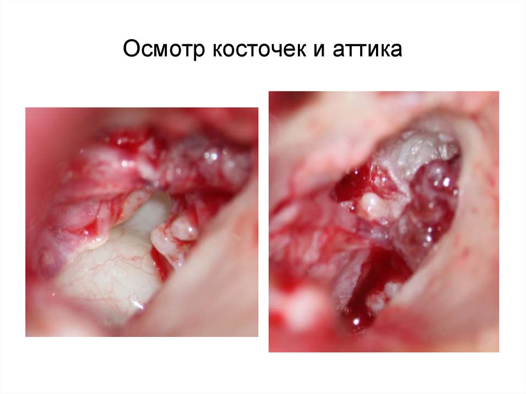 Осмотр косточек и аттика