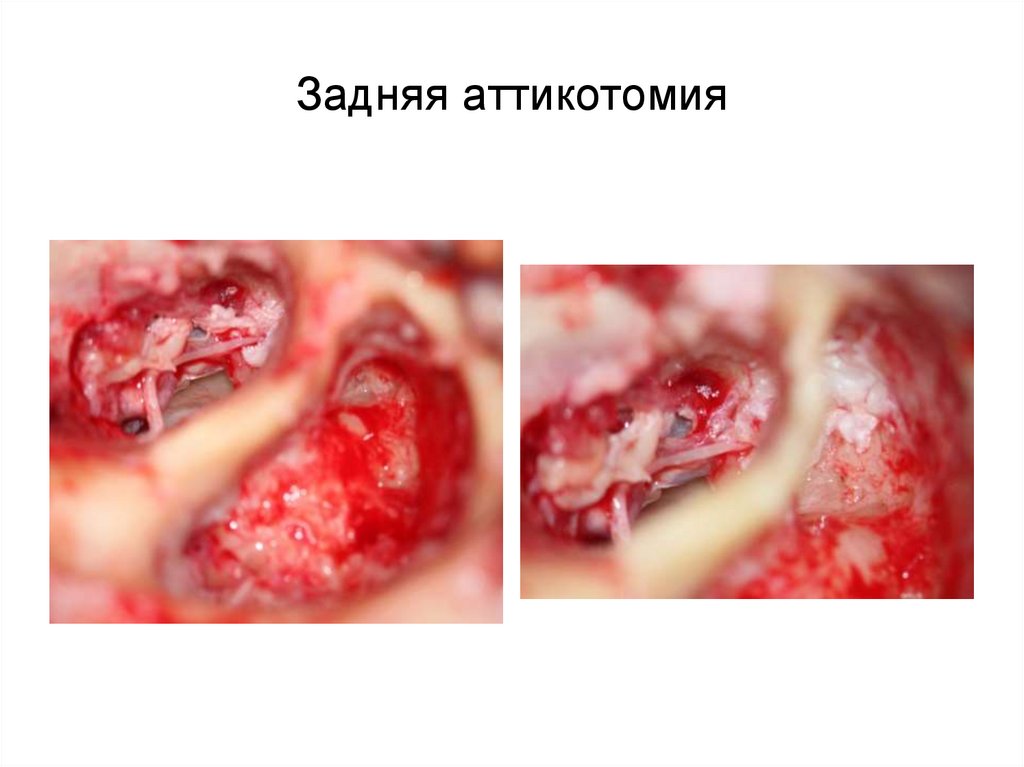 Задняя аттикотомия