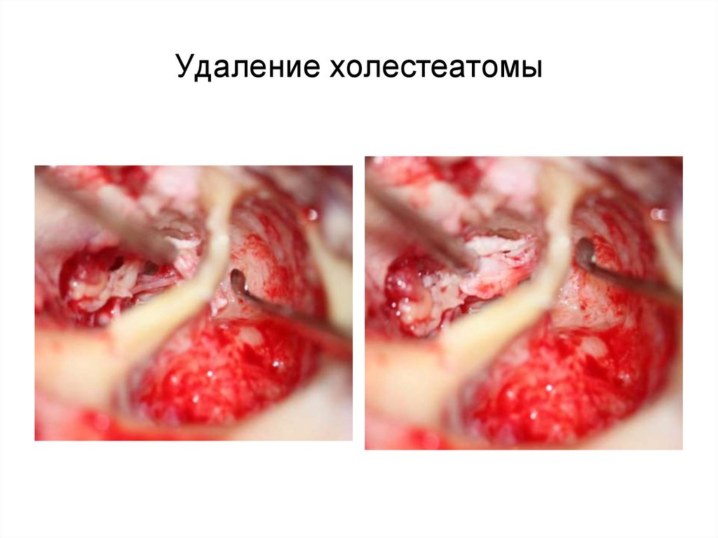 Удаление холестеатомы