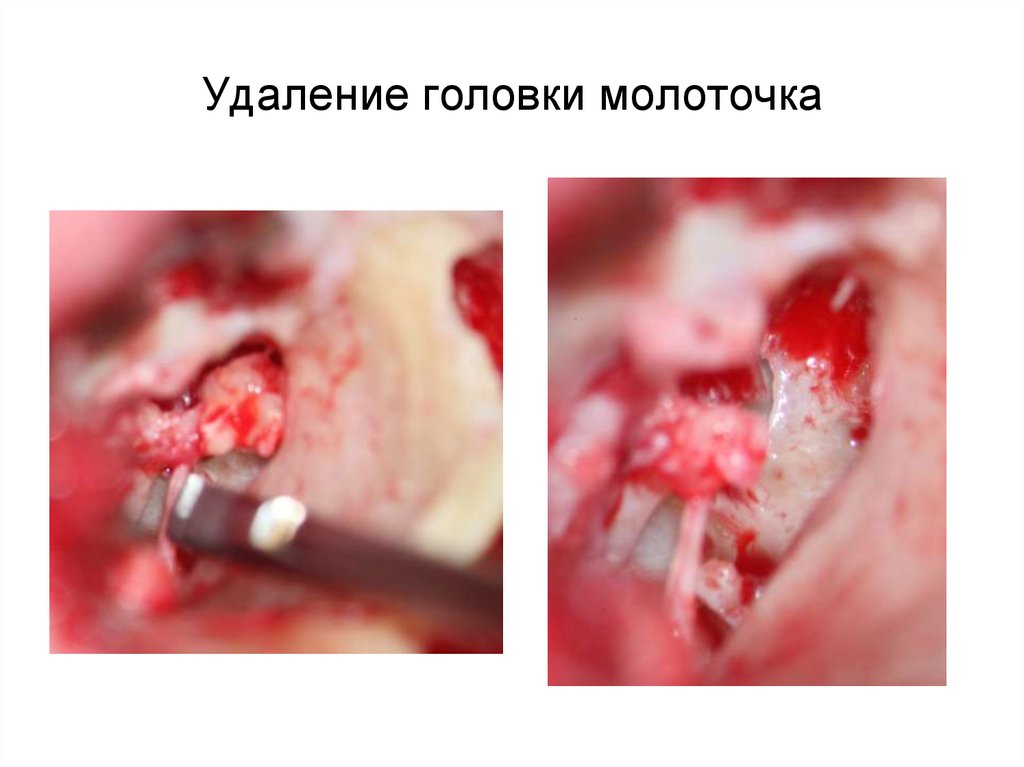 Удаление головки молоточка