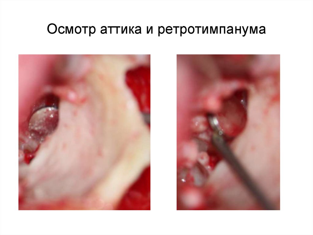 Осмотр аттика и ретротимпанума