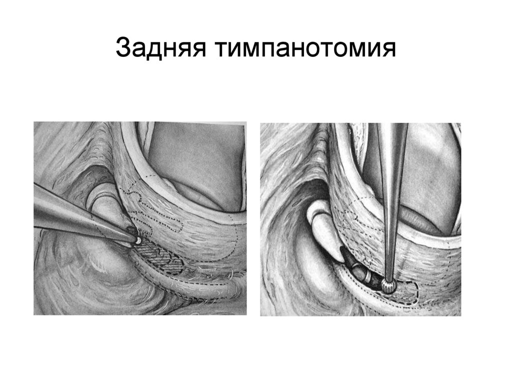 Задняя тимпанотомия