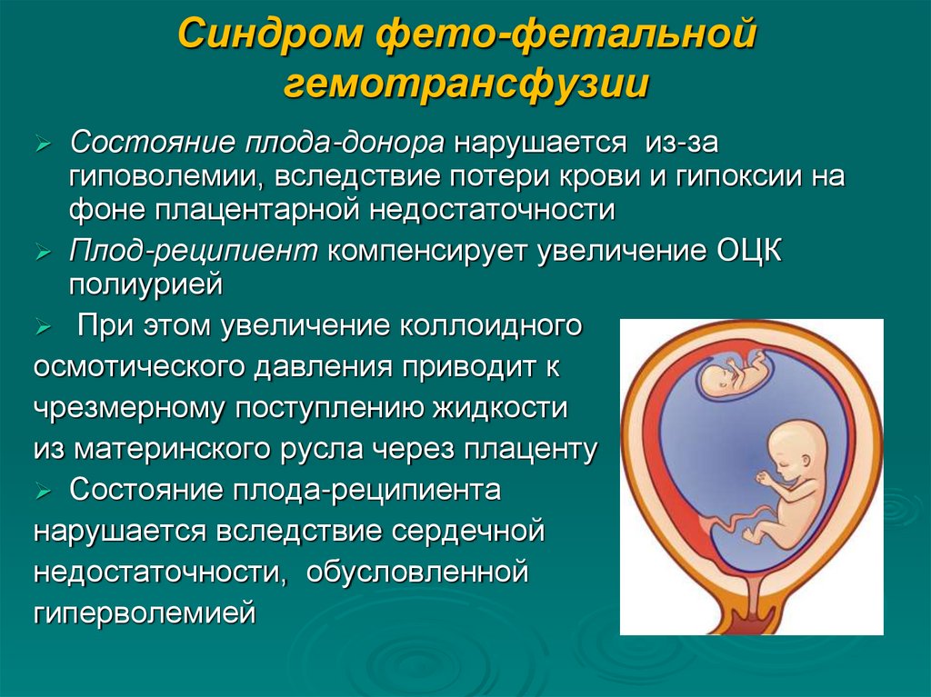 Синдром фето-фетальной гемотрансфузии