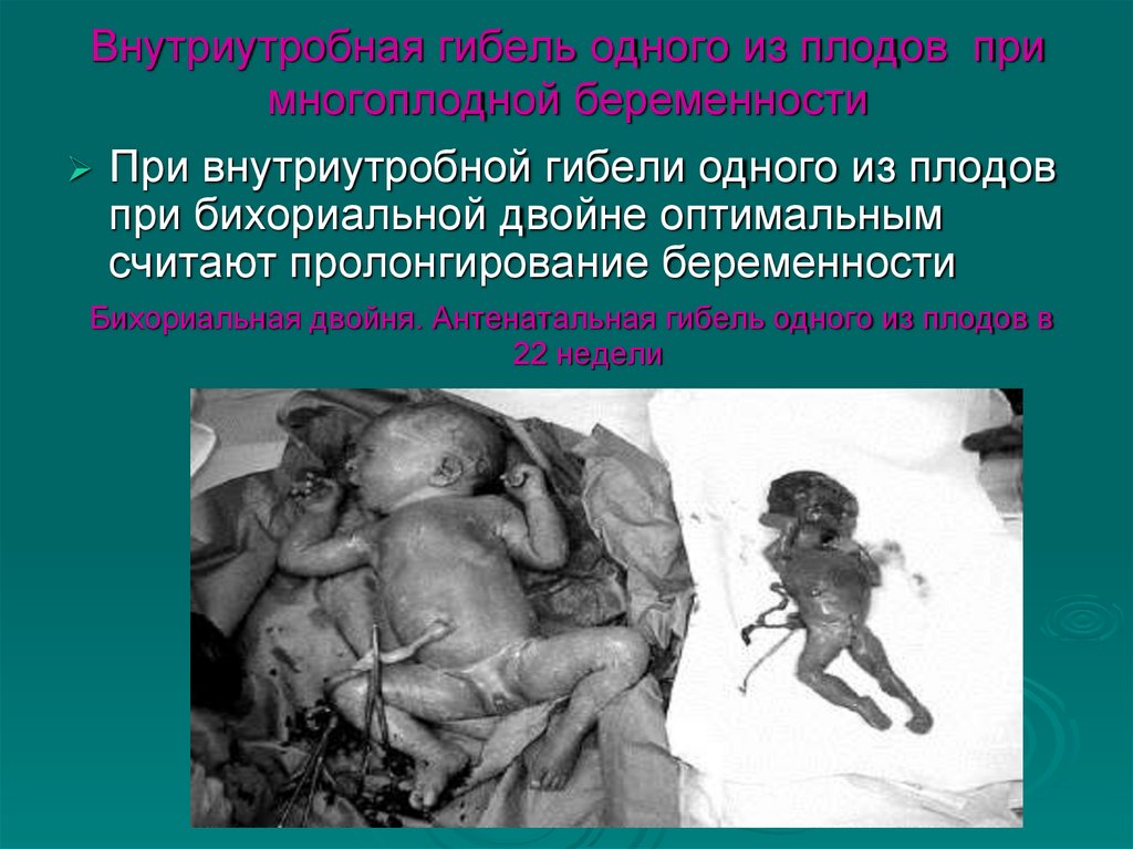 Внутриутробная гибель одного из плодов при многоплодной беременности