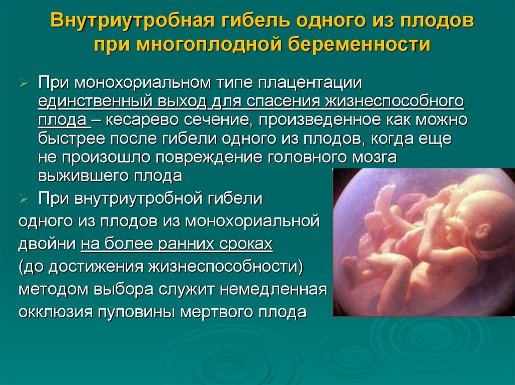 Внутриутробная гибель одного из плодов при многоплодной беременности