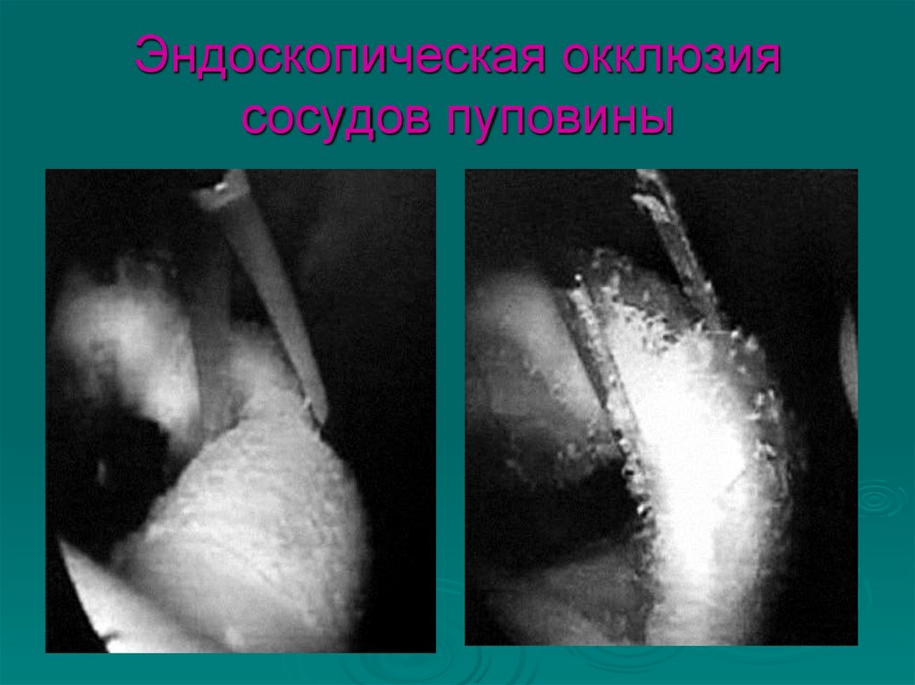 Эндоскопическая окклюзия сосудов пуповины