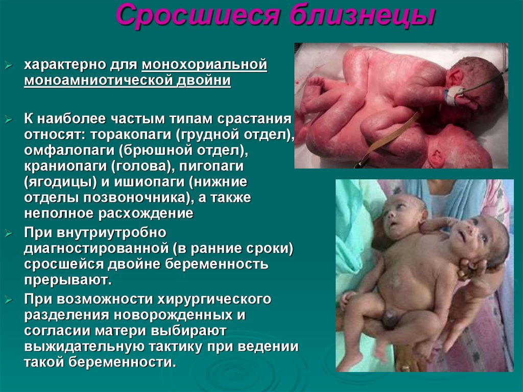 Сросшиеся близнецы