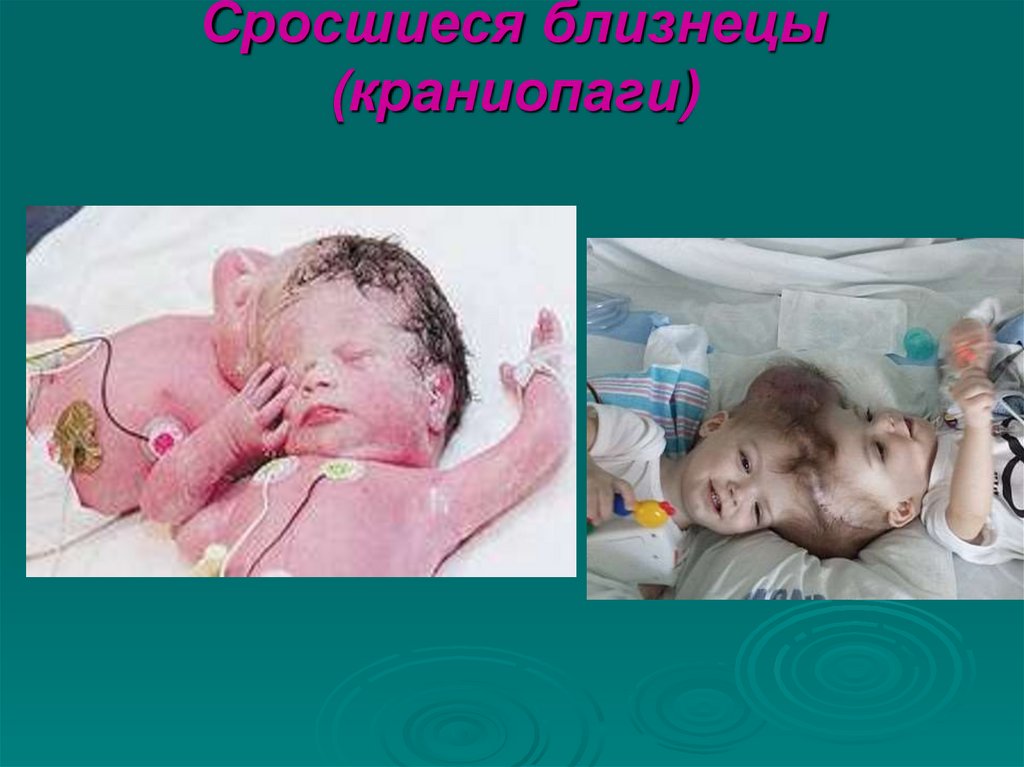 Сросшиеся близнецы (краниопаги)