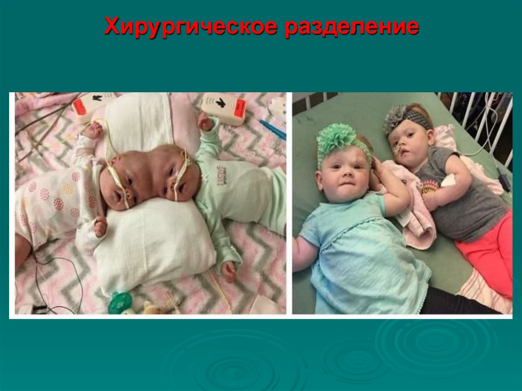 Хирургическое разделение