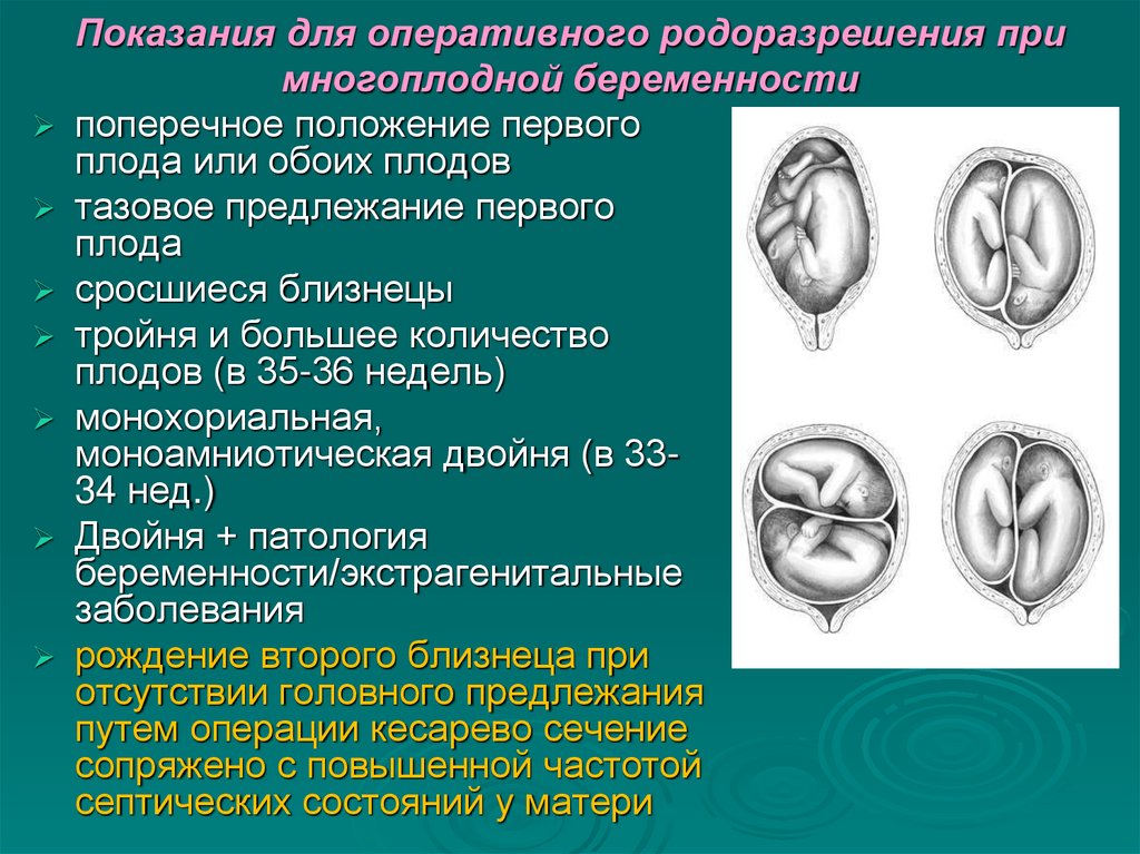 Показания для оперативного родоразрешения при многоплодной беременности