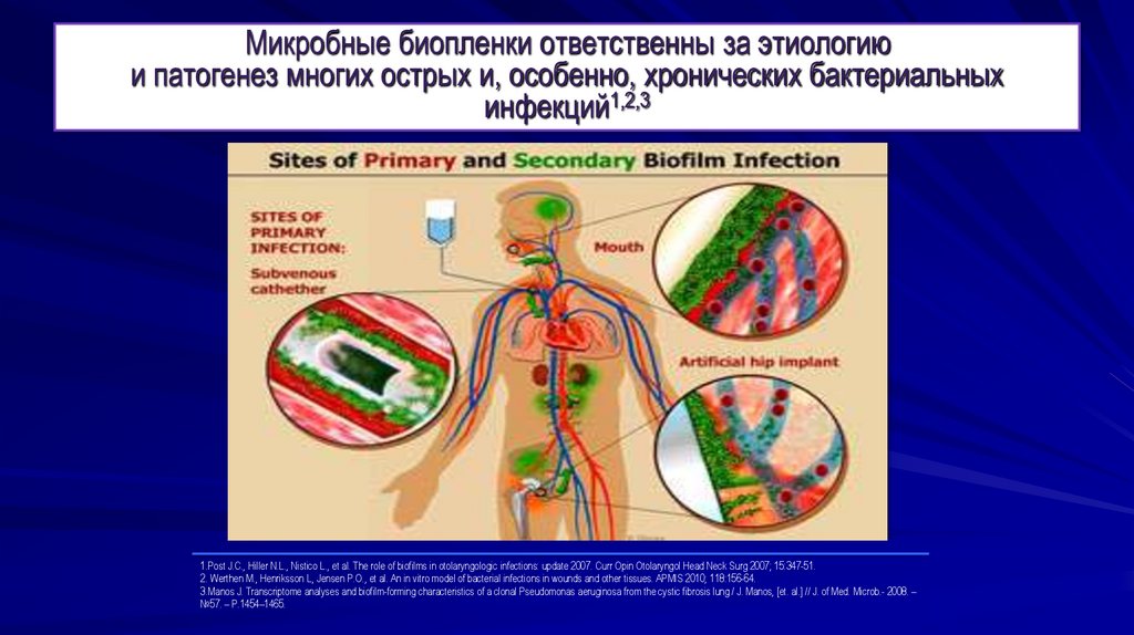 Микробные биопленки ответственны за этиологию и патогенез многих острых и, особенно, хронических бактериальных инфекций1,2,3