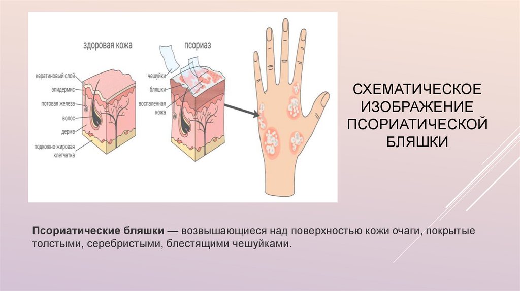 Схематическое изображение псориатической бляшки