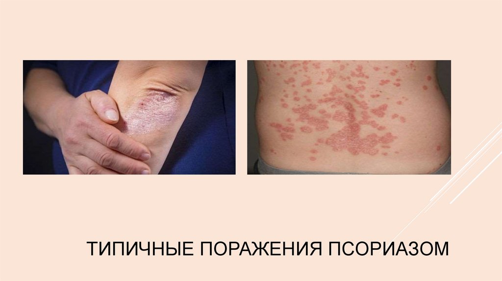 Типичные поражения псориазом