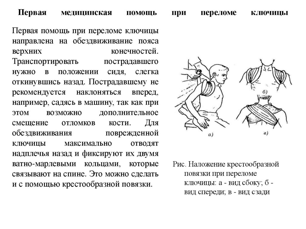 Первая медицинская помощь при переломе ключицы
