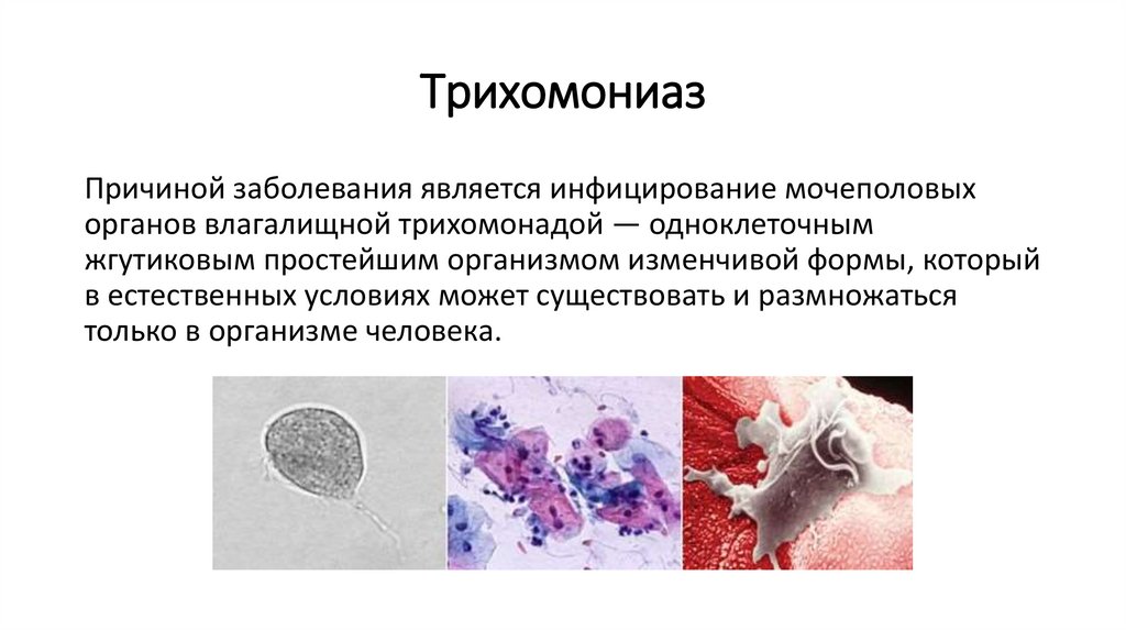 Трихомониаз