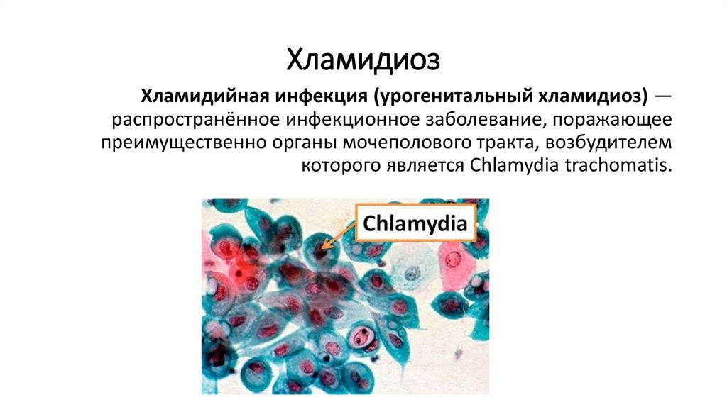 Хламидиоз
