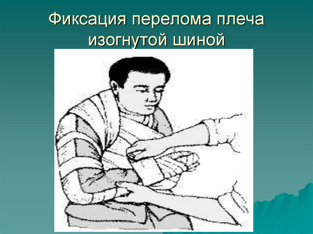 Фиксация перелома плеча изогнутой шиной