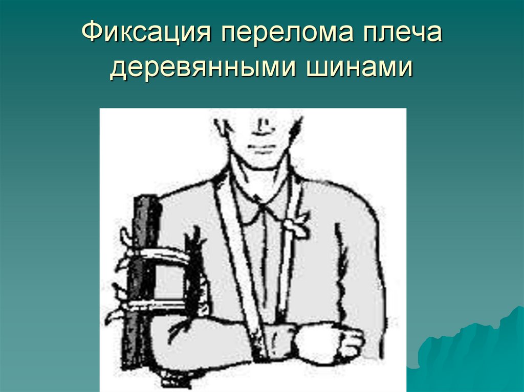 Фиксация перелома плеча деревянными шинами